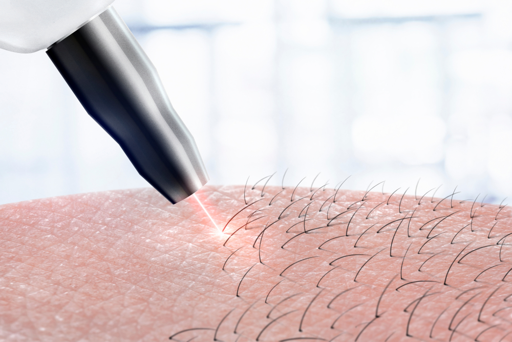 depilação a laser quanto tempo demora para cair os pelos
