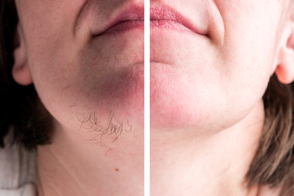 depilação a laser no rosto feminino antes e depois