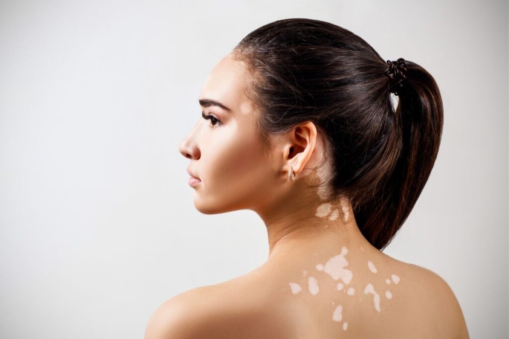 Pode fazer depilação a laser com vitiligo
