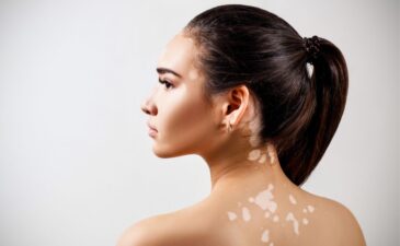 Pode fazer depilação a laser com vitiligo